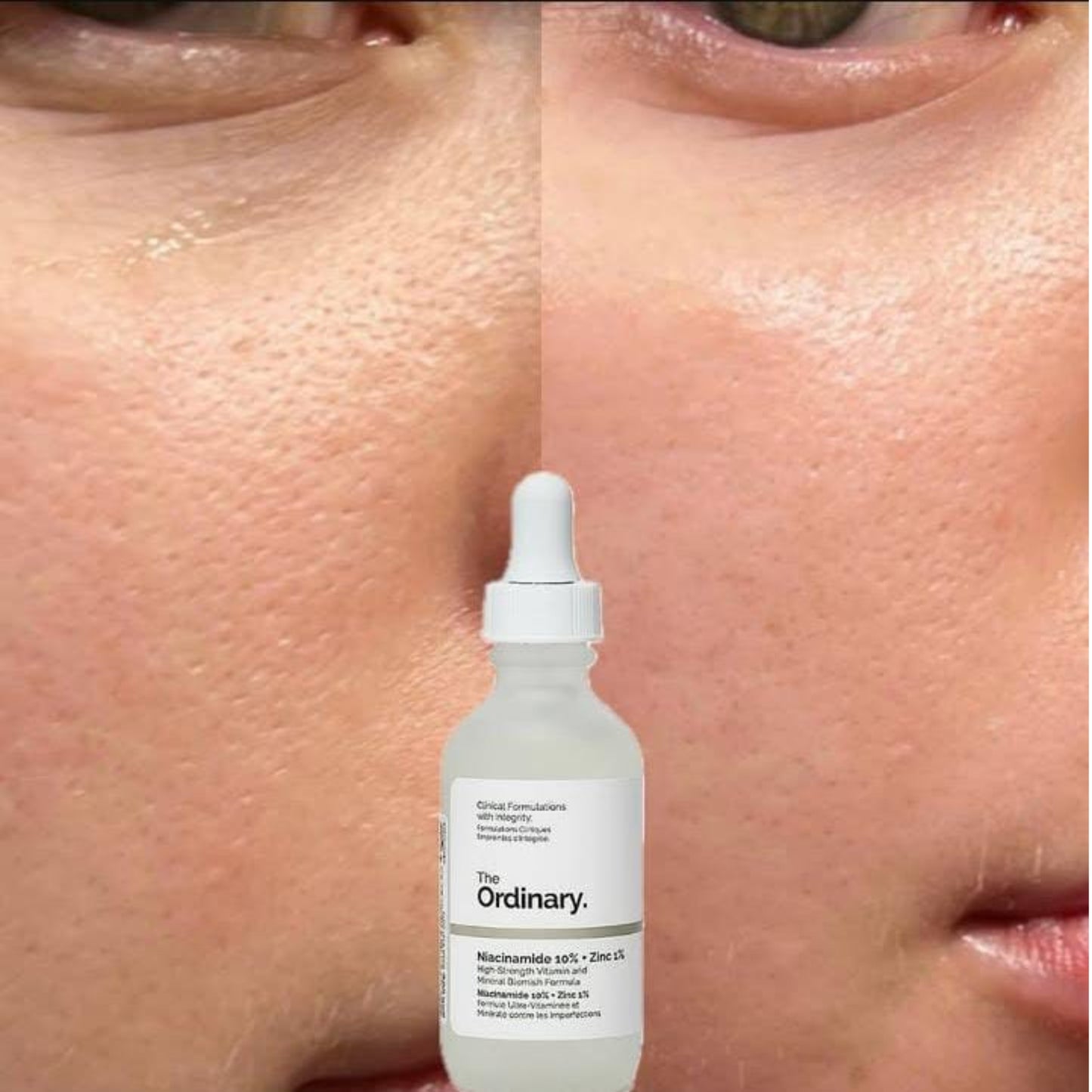 Niacinamida 10% + zinc 1% The Ordinary
